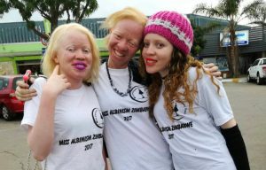 albinism_custom-39f5275b644ec6c2e8e50747599d5b8487d23e2f-s900-c85