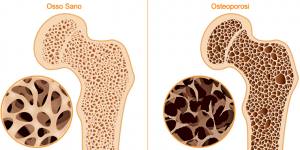 Osteoporosi