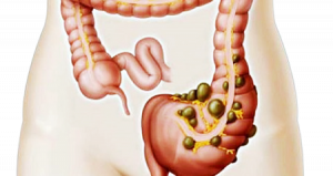 Intestino-affetto-da-colite-ulcerosa-removebg-preview