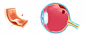 Distacco_Della_Retina_Poliambulanza-removebg-preview