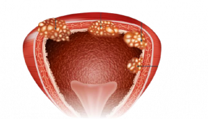 1cancro-della-vescica-stadi-tumorali-cancro-della-vescica-capire-focus-persona-removebg-preview