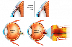 1glaucoma-removebg-preview