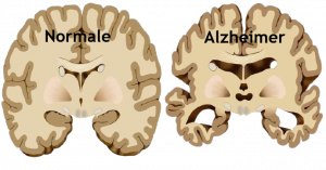 cervelloalzheimer