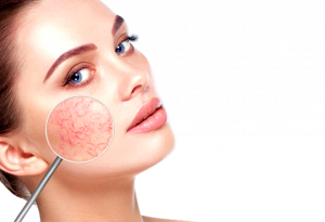 Rosacea-removebg-preview