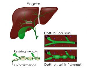 cirrosi-biliare-primitiva