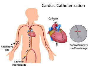 cateterismo_cardiaco