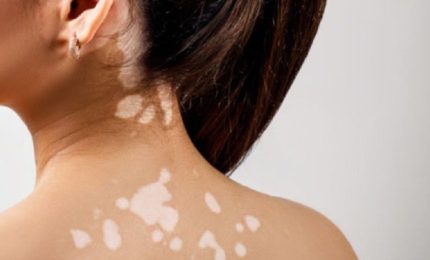 La 'Settimana della Vitiligine' approda anche in Sicilia: consulenze dermatologiche gratuite